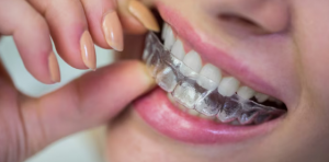 What is Invisalign Made of And How Much Better is That Material?